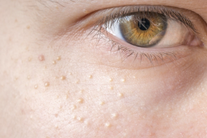 7 Reasons Why White Bumps Appear on Your Skin and How to Fix Them