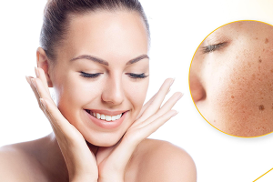 Understanding Hyperpigmentation: Causes, Types, and Effective Treatment Strategies