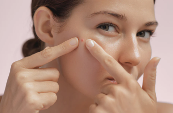 Think You Know Acne? 4 Common Myths Debunked by a Skin Expert
