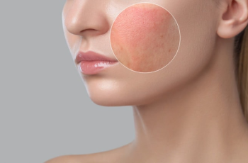 Skin Allergies and Skincare: Causes, Symptoms, and Treatment Guide Skin Allergies and Skincare: Causes, Symptoms, and Treatment Guide