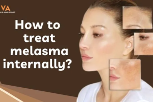 How to Treat Melasma Naturally and Get Even Skin