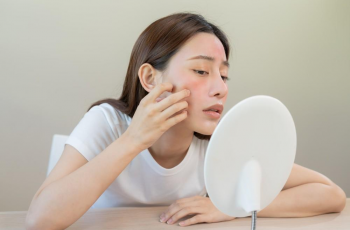 Fungal Acne: The Hidden Culprit Behind Stubborn Breakouts