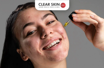 How Salicylic Acid Works: The Ultimate Guide to Clearer Skin