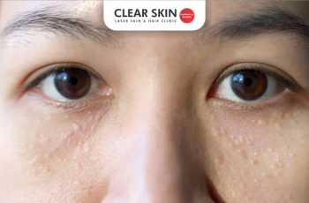 Clear Skin Ahead: The Best Natural Solutions for Getting Rid of Milia