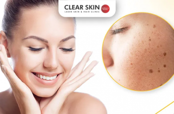How to Get Rid of Face Spots Fast: Effective Tips for Clear, Radiant Skin