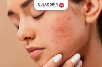 Fast-Acting Pimple Solutions for Clearer Skin Overnight Fast-Acting Pimple Solutions for Clearer Skin Overnight