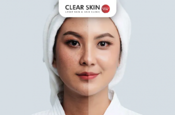 How to Fade Melasma Internally for Clearer Skin