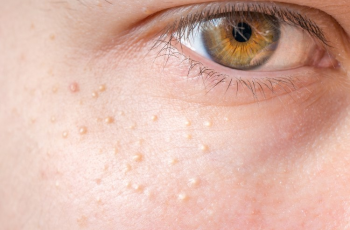 Can Salicylic Acid Clear Keratosis Pilaris? The Truth Explained