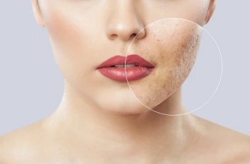 Does Makeup Cause Acne? Here’s How to Prevent Breakouts Does Makeup Cause Acne? Here’s How to Prevent Breakouts