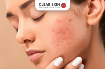 Filler Treatments for Acne Scars: A Complete Skincare Transformation Guide Filler Treatments for Acne Scars: A Complete Skincare Transformation Guide
