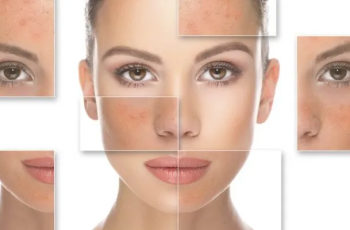 How Often Should You Use Mandelic Acid Peels Safely?