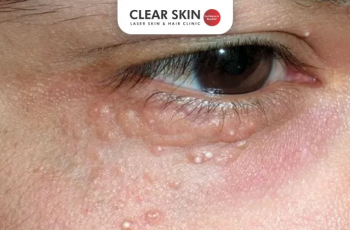 Natural Skincare Guide to Remove Milia and Smooth Your Skin Natural Skincare Guide to Remove Milia and Smooth Your Skin